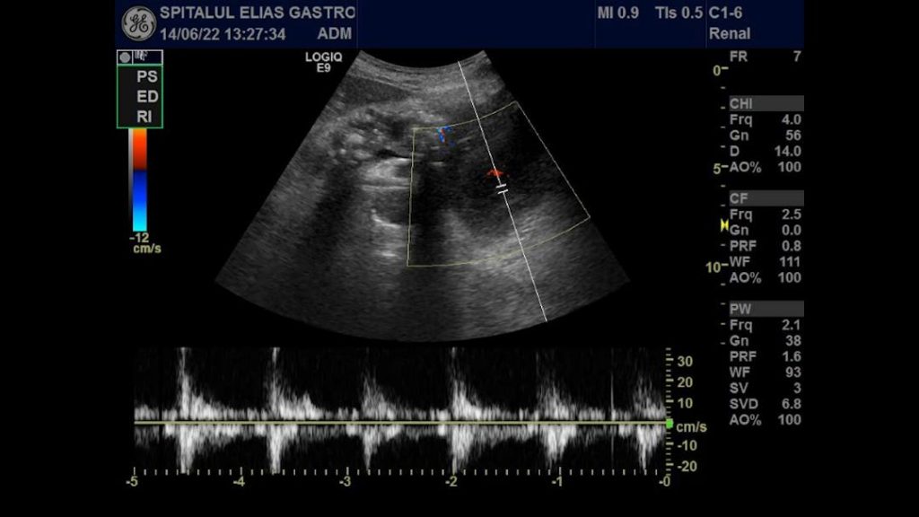 sessile cecal polyp icd 10